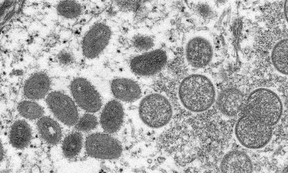 Third possible case of monkeypox found in the U.S